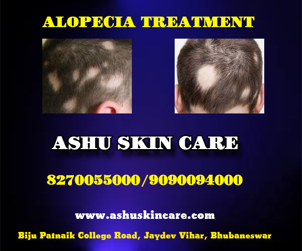 best alopecia treatment clinic in bhubaneswar near ayush hospital